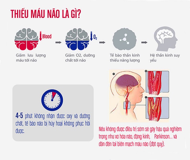 Thiếu máu não ở người già: Nguy cơ cao dẫn đến đột quỵ