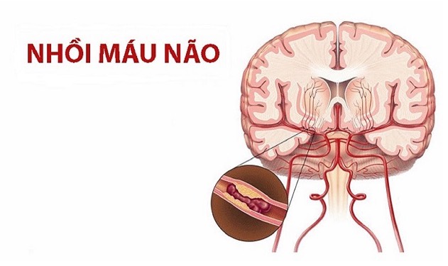 Hướng dẫn phân biệt nhồi máu não và xuất huyết não chuẩn theo chuyên khoa